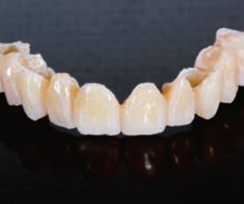 Протез из Luxatemp Fluorescence